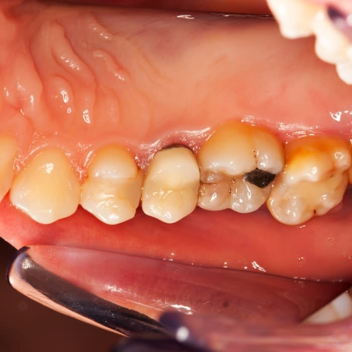 The Great Debate: Can Genetics Cause Cavities? | Best Dentist in Arlington, Tx - Mark C. Marchbanks D.D.S.