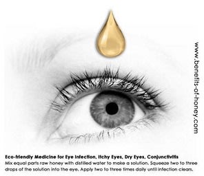 Cure Eye Infection with Honey in 24 Hours