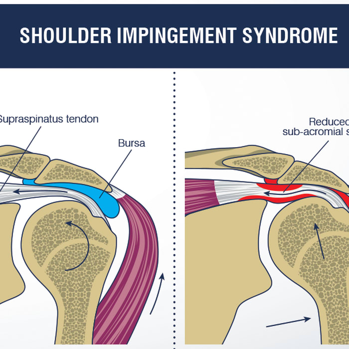 Shoulder Impingement Syndrome : Symptoms,Causes,Diagnosis & Treatment » How To Relief