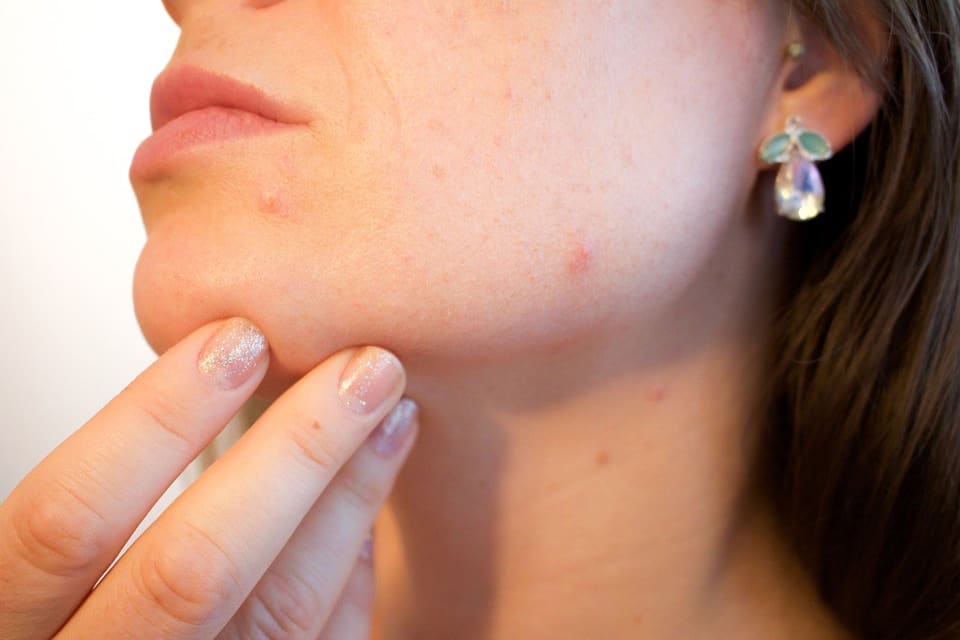 How to pop a pimple safety and side effects