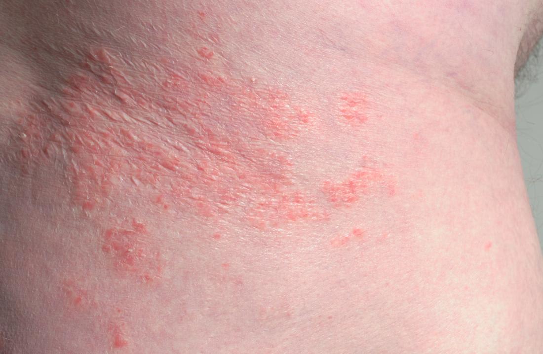 What should you knowAbout Psoriasis Skin Disease?