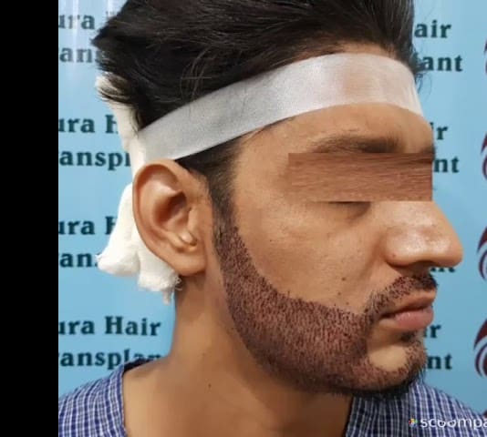 Client Before and After Results - Beard Hair Transplant