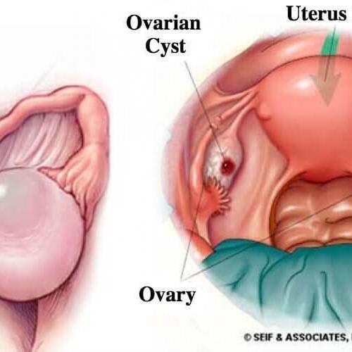 9 warning signs of ovarian cysts that women often ignore - Mind & Health