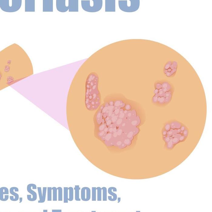 Psoriasis - Types, Symptoms, Causes and Treatment