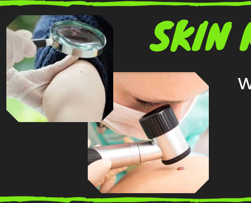 All You Need to Know About Skin Mole Removal Treatment