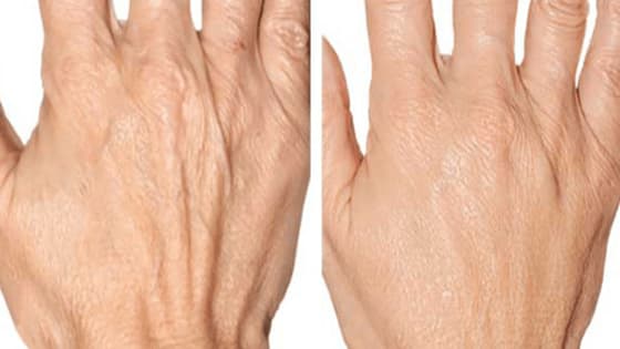 How To Get Rid Of Wrinkles On Hands - Skin Care Tips