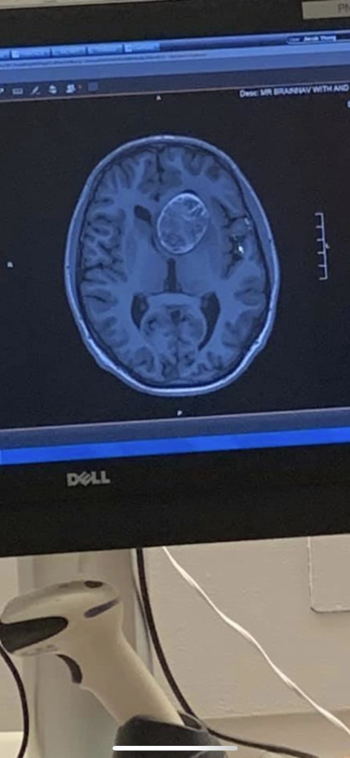 A CT scan of my brain and the 6.2 cm dermoid cyst I had surgically removed in January of 2019. My brain somehow managed to grow around it without causing me to become mentally or physically disabled for 22 years.