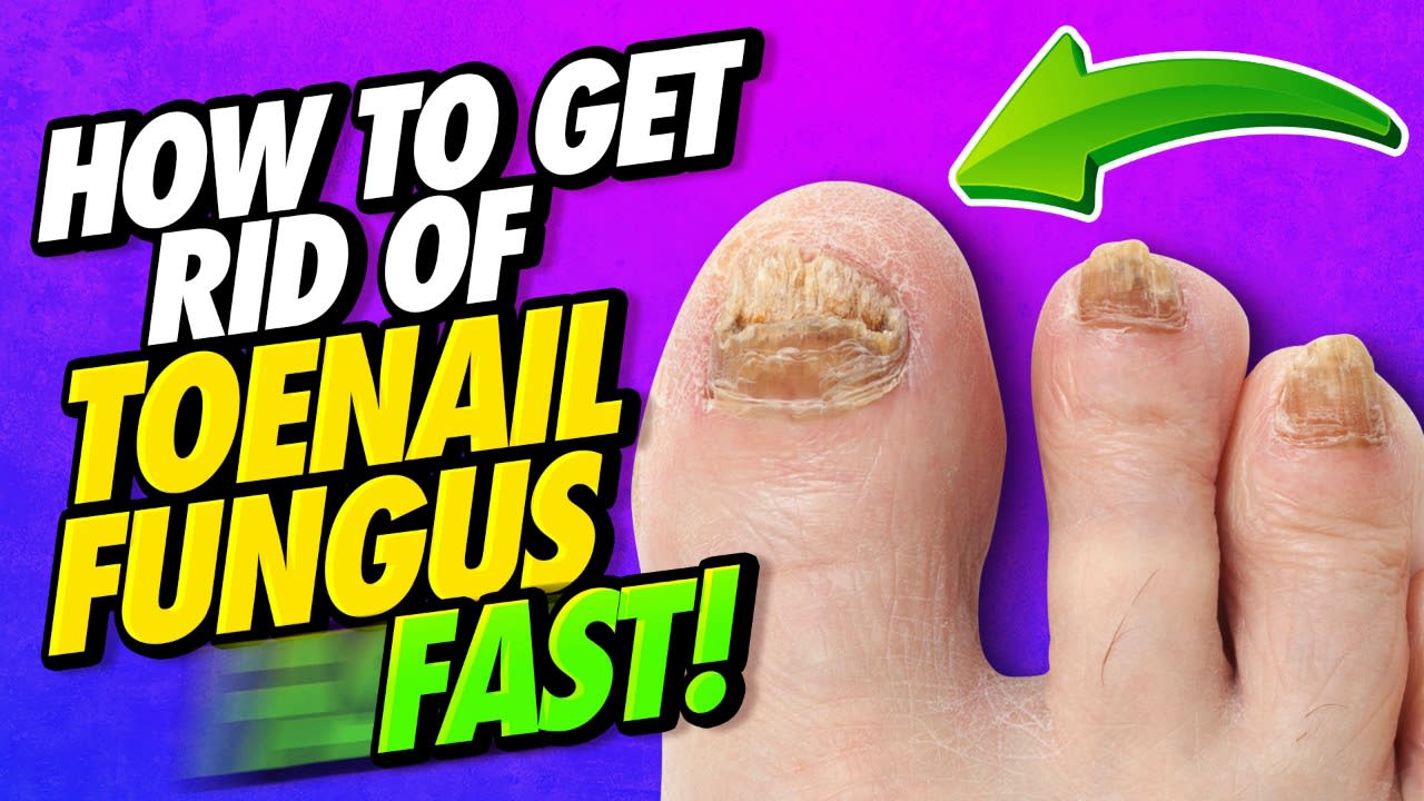 How To Get Rid of Toenail Fungus FAST!!!