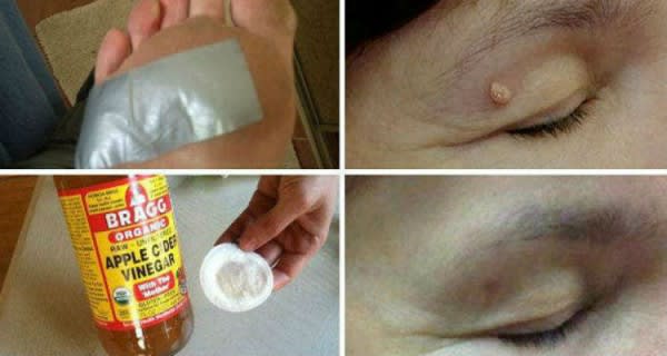 Remove Warts, Dark Spots, Blackheads And Skin Tags Quickly And Effectively With These Natural Remedies!