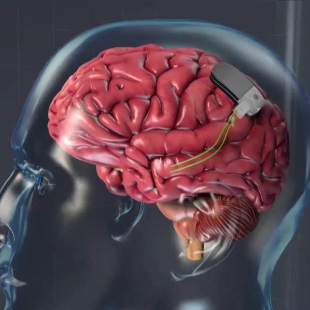 An innovative medical device combined with medication could tame epileptic seizures