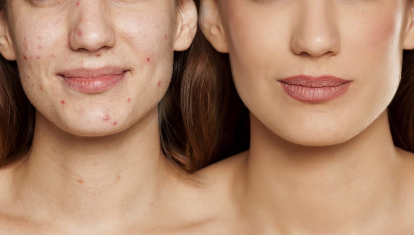 ACNE PROGRAM - AnewSkin Aesthetic Clinic and Medical Spa DC