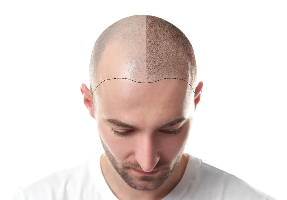All You Need to Know Before Getting a Hair Transplant