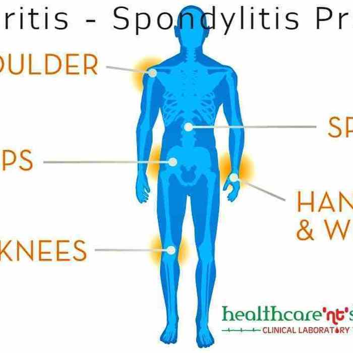 Affordable Arthritis Test Packages In Pune