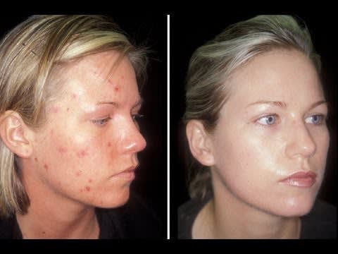 HOW TO: CURE ACNE!!!! - CLEAR SKIN IN ONE WEEK