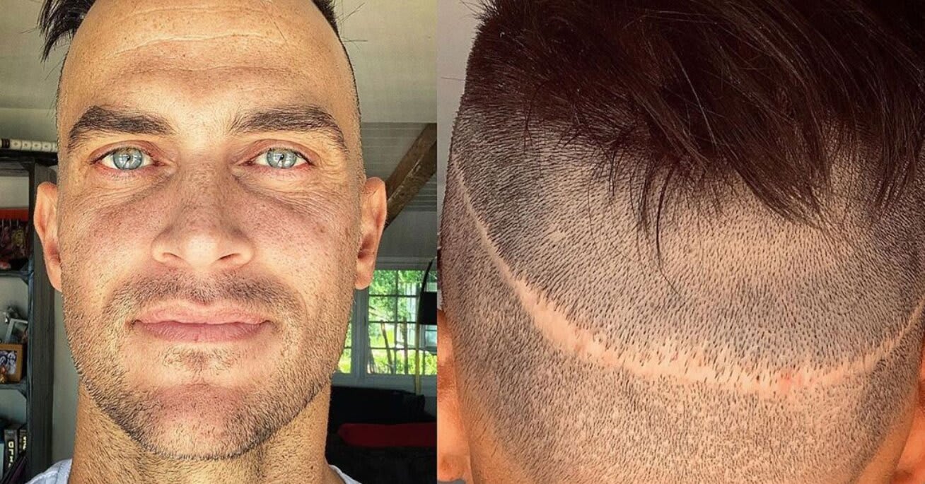 Cheyenne Jackson Reveals He's Had 5 Hair Transplant Surgeries: 'I Hid It from Everyone'