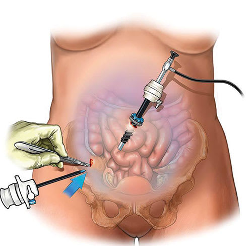 Cancer Surgery using Laparoscope