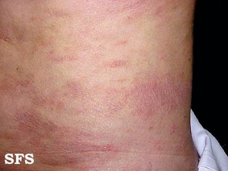 Lifestyle and Health, Cure Psoriasis and its Causes
