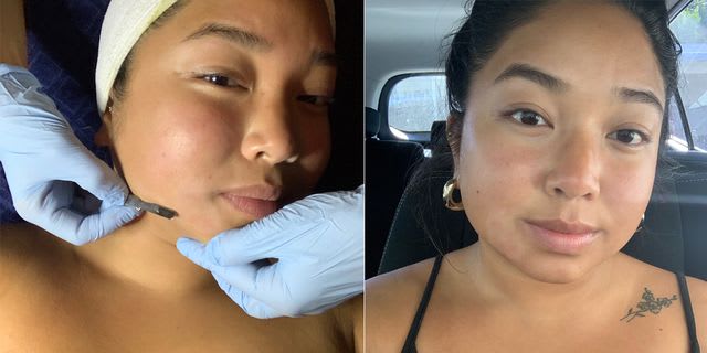 The Weirdly Effective Beauty Treatment That Uses a Scalpel