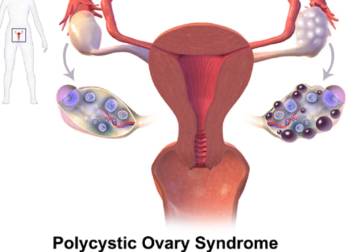 Polycystic ovarian syndrome (PCOS) symptoms and treatments