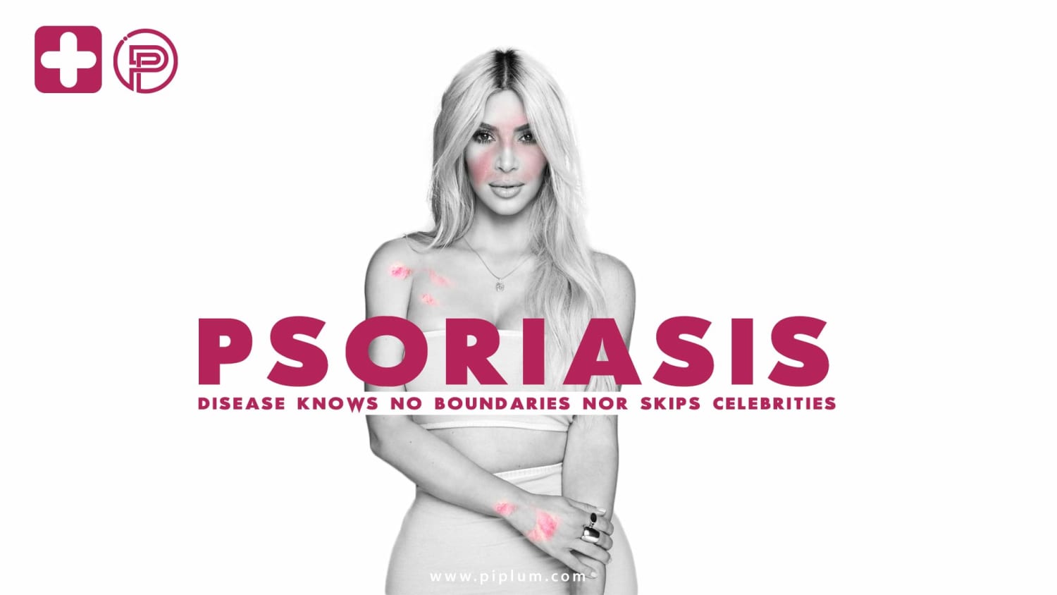 Psoriasis. Discover The Full Guide Of Symptoms, Treatments, And Causes