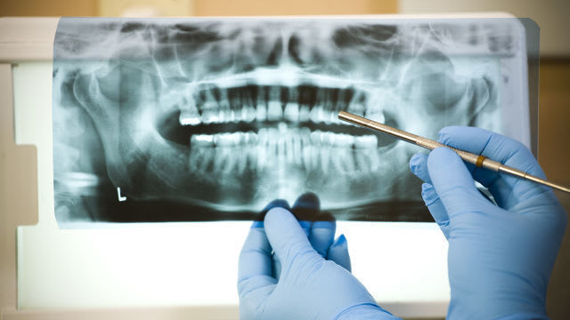 Root Canal Complications: What You Need to Know