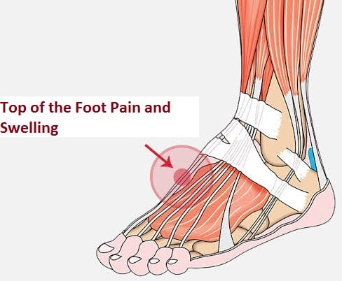 Top of the Foot Pain and Swelling Treatment - Your Health Guideline
