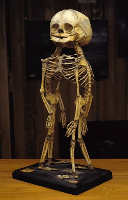 This skeleton of conjoined twins at the Mütter Museum