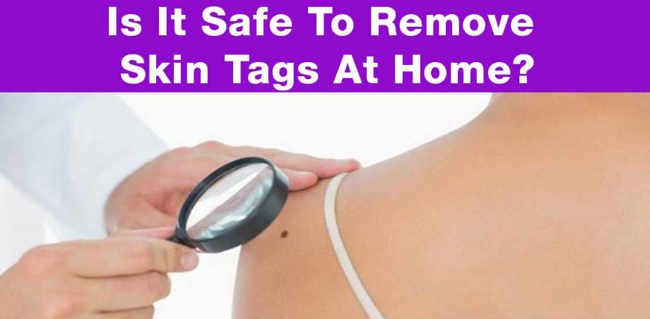 Skin Tag Remover Reviews : Skincell Pro Best Skin Tag Removal Cream