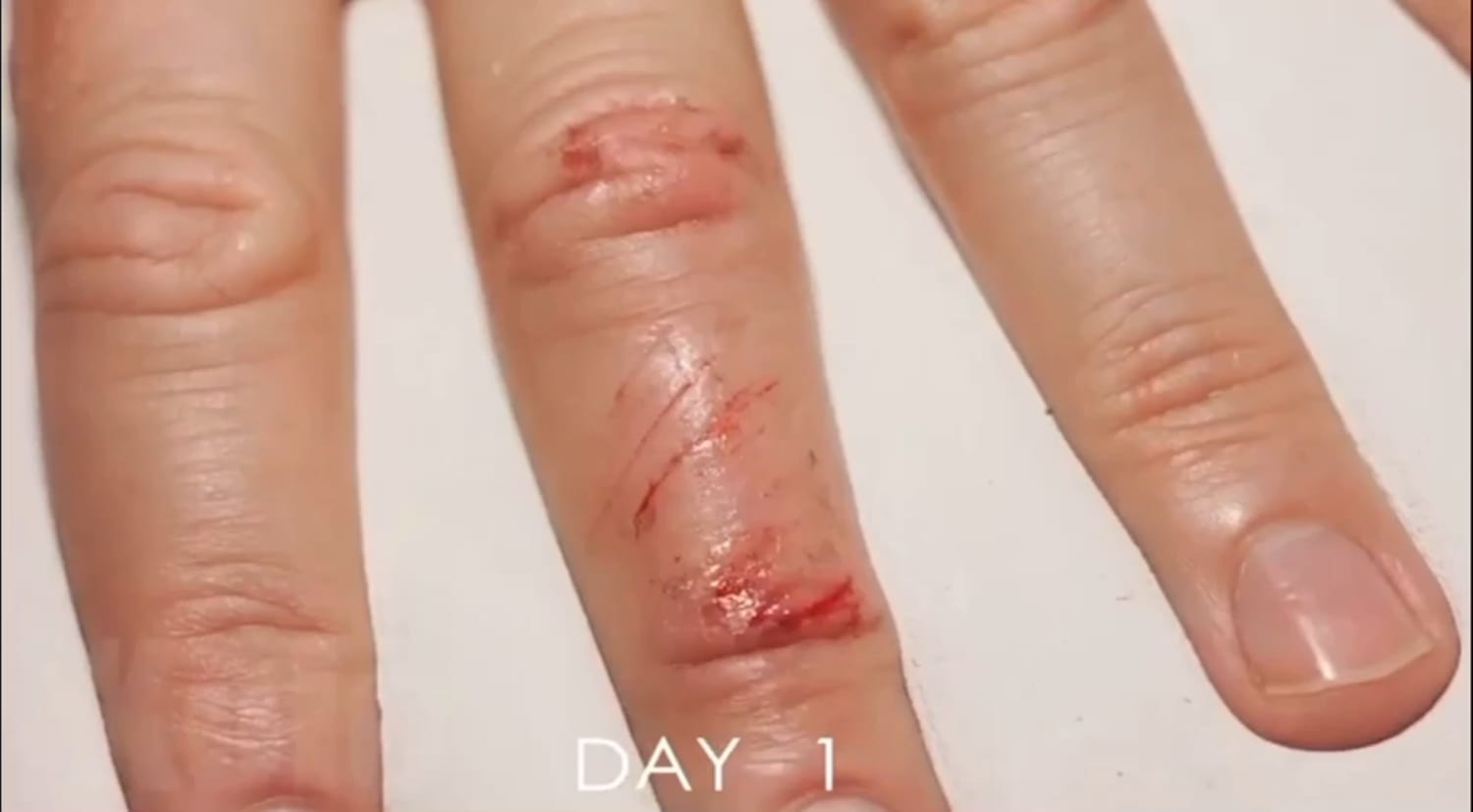 Time lapse of healing wound