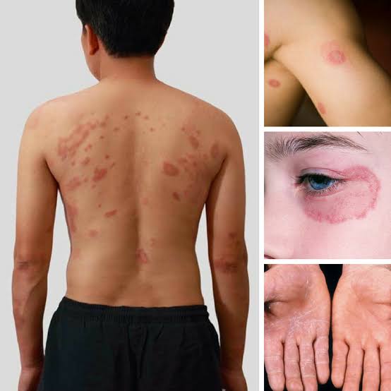 9 Really Useful Home Remedies For Fungal Infection On Body