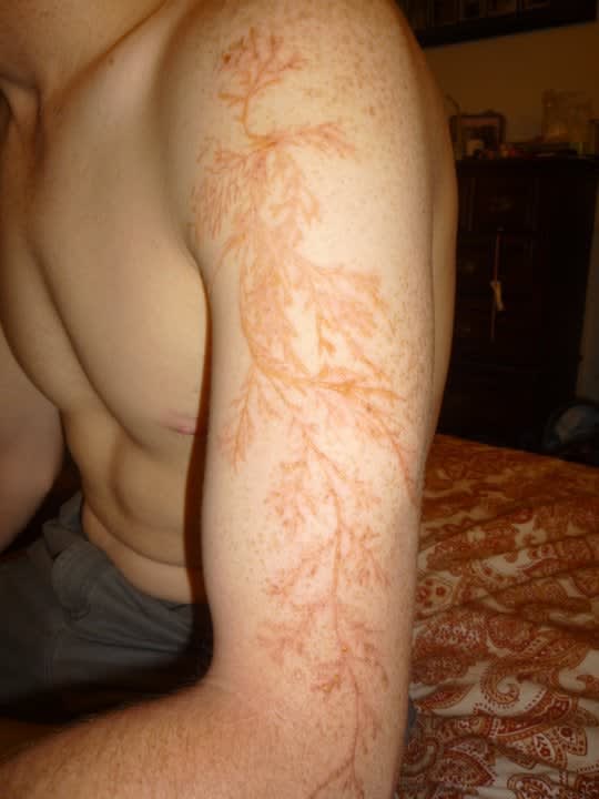 A lightning strike left a scar like this on mans arm