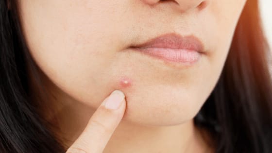How To Get Rid Of Pimples That Hurt - Skin Care Tips