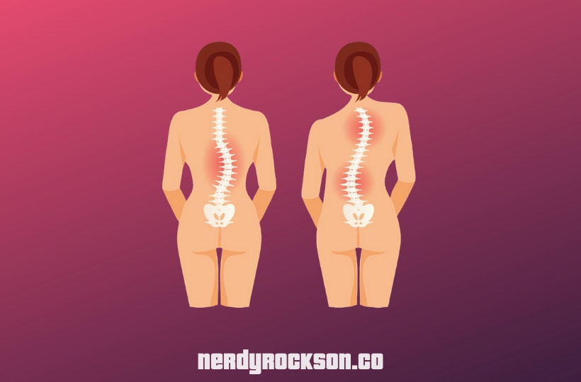 Natural Remedies to Treat Scoliosis