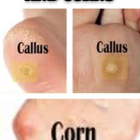 THE BEST HOMEMADE MEDICINE AGAINST CALLUSES AND CORNS