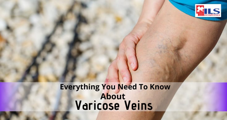 Everything You Need To Know About Varicose Veins