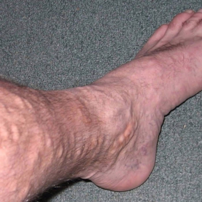 Varicose Vein Treatment Market is Estimated to Hit $417.59 million by 2023