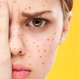 Symptoms of Chicken Pox and the Causes You Need to Know