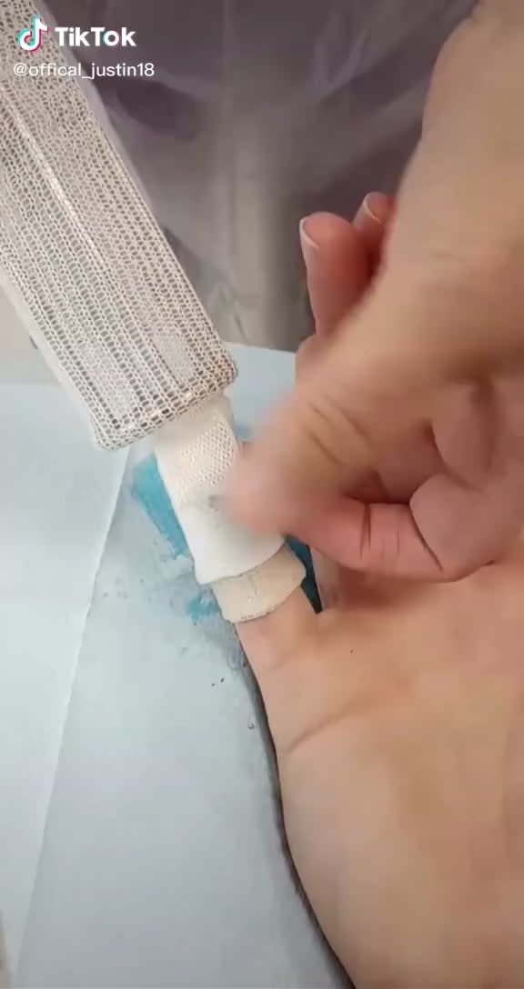 Tool used to wrap a finger after a burn or injury.