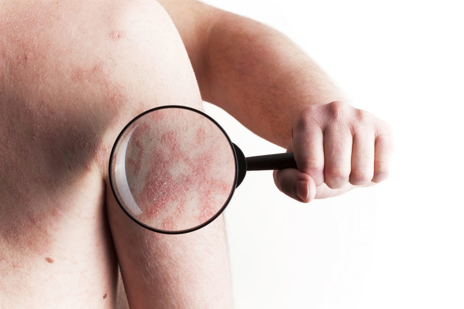 6 Things That Can Make Psoriasis Better