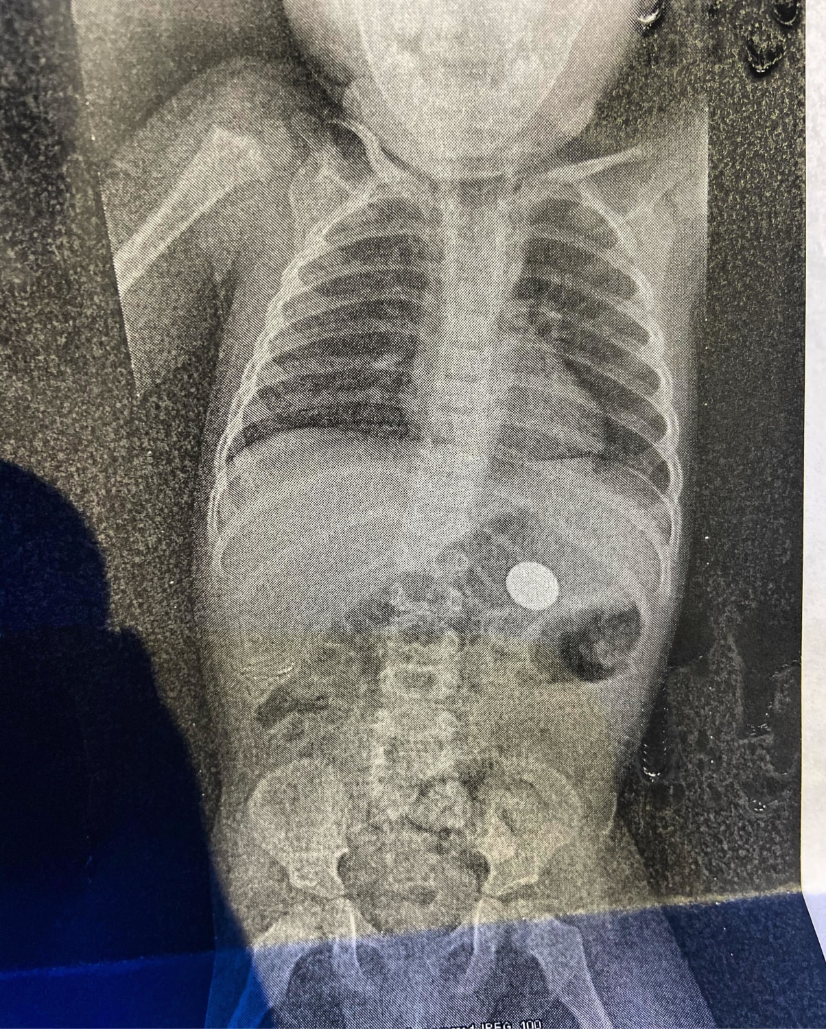 On Valentine’s Day my son decided to show me his first Magic trick how to make a coin disappear............1 X-ray later I found it 🤦‍♂️❤️