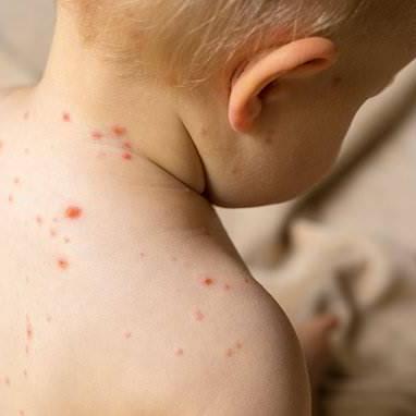 Colorado parents are holding 'chickenpox parties' to infect their kids