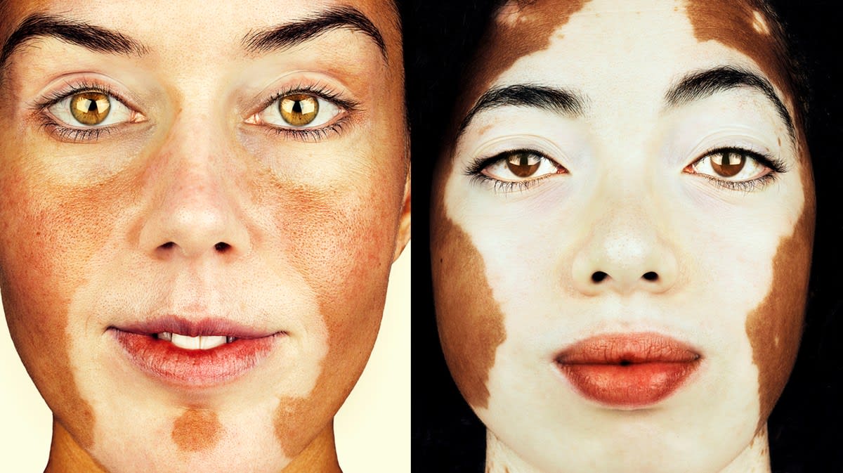 this photographer is shooting almost 100 people with vitiligo