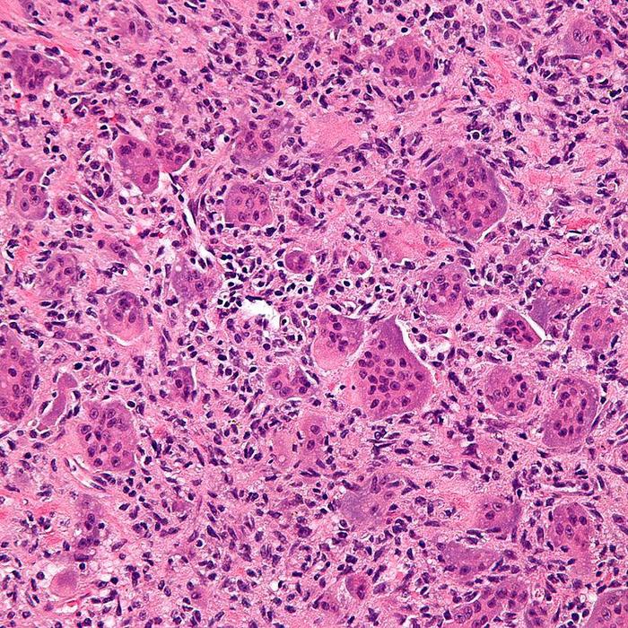 Giant-cell tumor of bone
