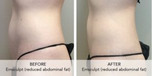 Muscle: Emsculpt Changing the Way to a Fitter Body - Natural Look Medical Spa