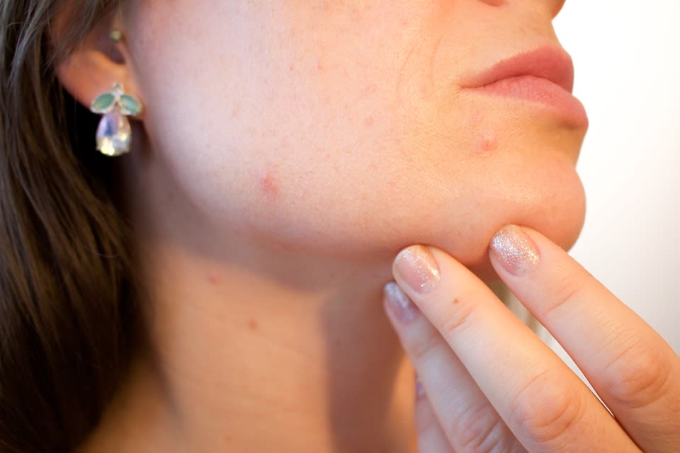 How to get rid of acne scars