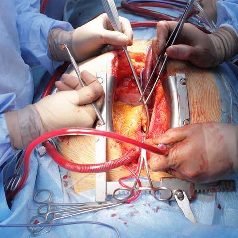Adult Cardiac Surgery Ranchi , Cardiac Surgeons in Ranchi