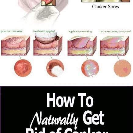 How to Naturally Get Rid Of Canker Sores In Minutes With This Home Remedies