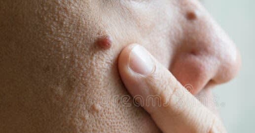 HOW TO REMOVE A MOLE NATURALLY