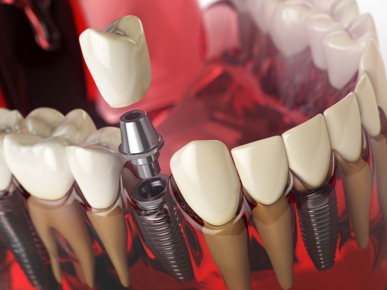 What are the benefits of permanently replacing teeth?