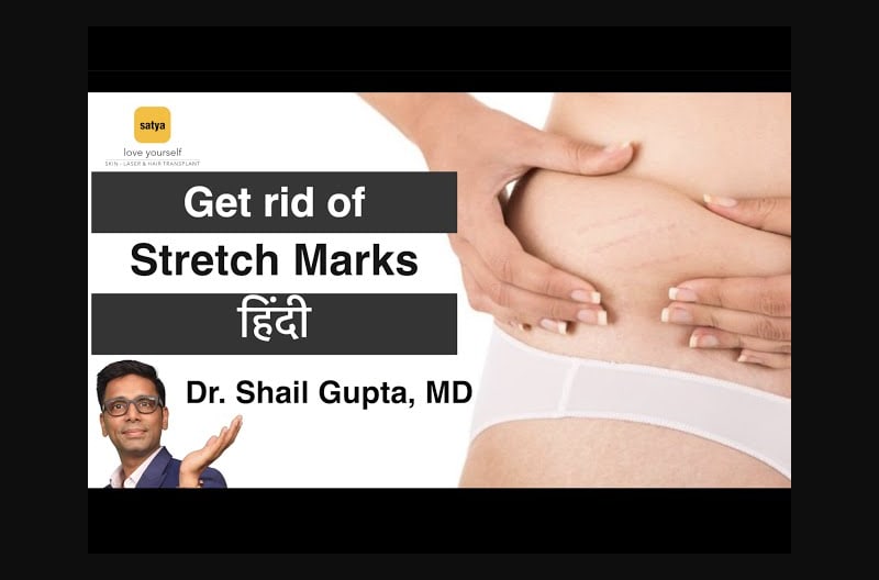 Stretch Marks Removal, Get rid of Stretch Marks (Hindi) by Satya Skin Clinic